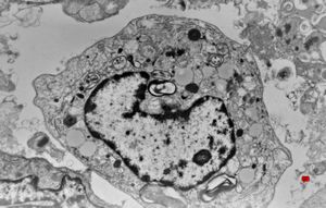 F, 2m. | surfactant deficiency- alveolar macrophage F, 2m. | surfactant deficiency- alveolar macrophage